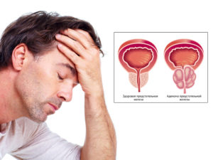 adenoma-prostatyi