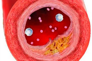 Aterosklerotic