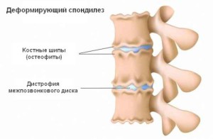Spondilez
