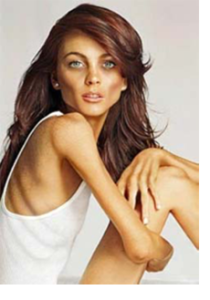 anorexia