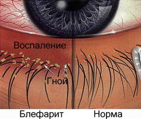 blefarit