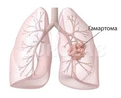 gamartoma