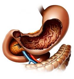 gastritis