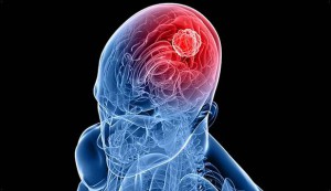 glioma