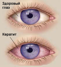 keratit