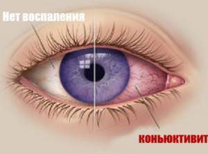 konyuktivit