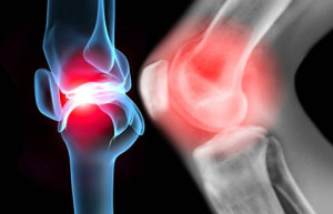 X ray of knee leg in pain
