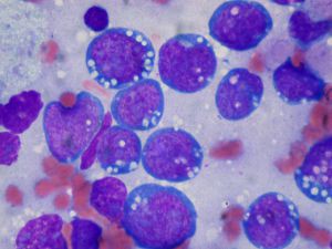 limfoma
