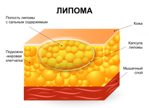 lipoma