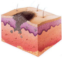 melanoma