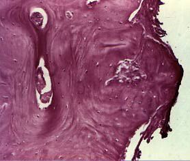osteoma