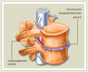 protruzia