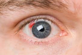 retinopatiya