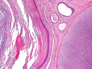 teratoma