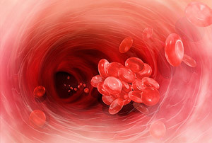 thrombophlebitis