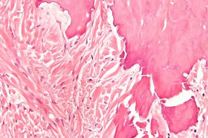fibroma