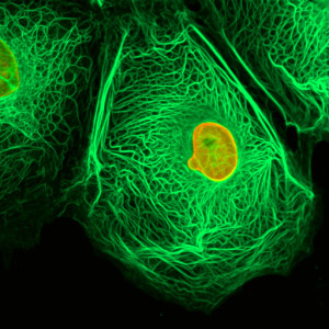 horiokarcinoma